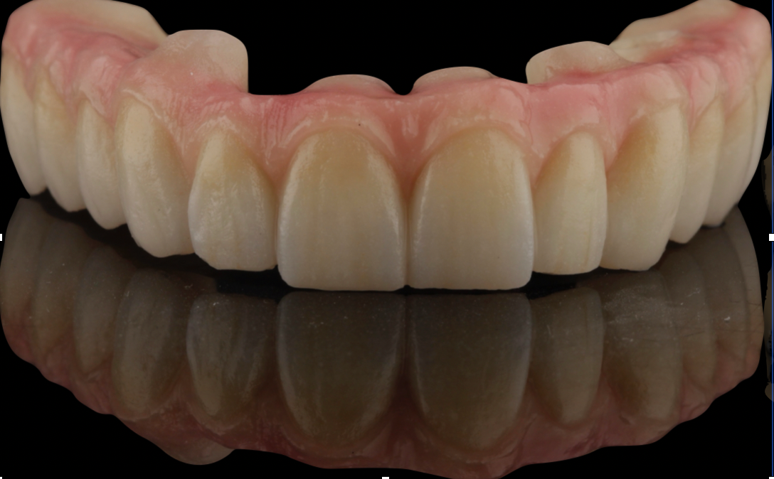 Rehabilitación oral completa sobre implantes