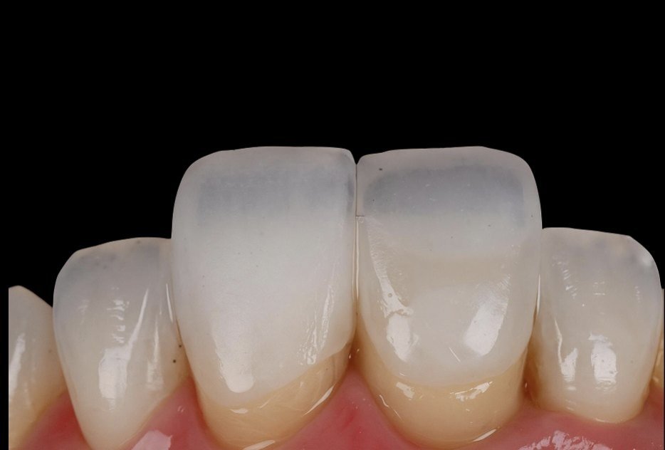Detalle de una restauración cerámica: translucidez en el borde incisal y textura de superficie.