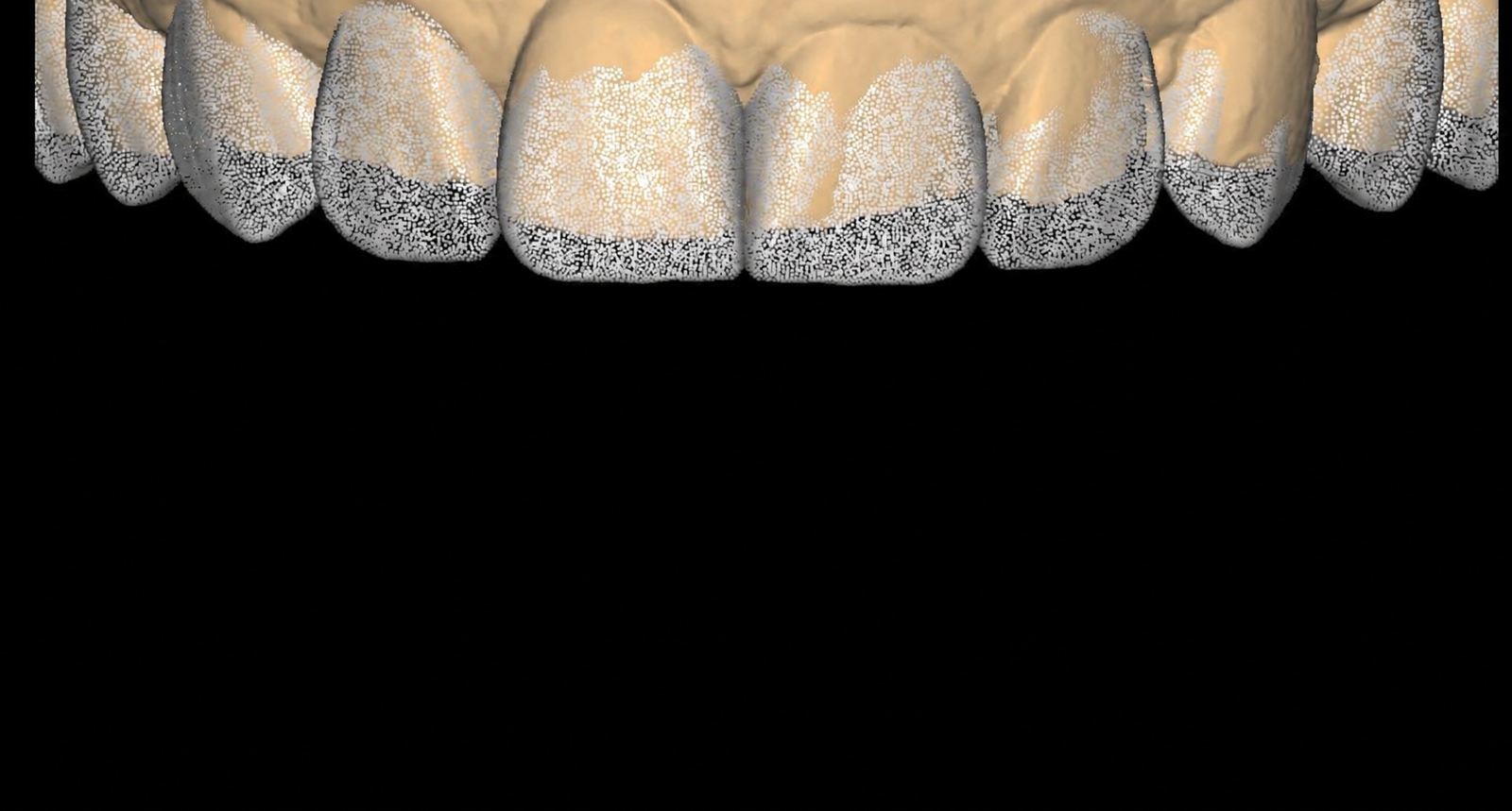 Diseño de sonrisa con carillas — resultado natural